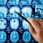 SHOCKING Discovery: Organ Fat Destroys Memory A hand pointing at MRI brain scans displayed on a screen